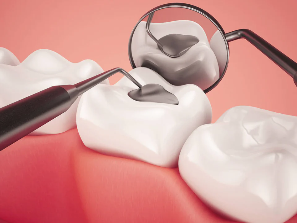 Fillings and Sealants